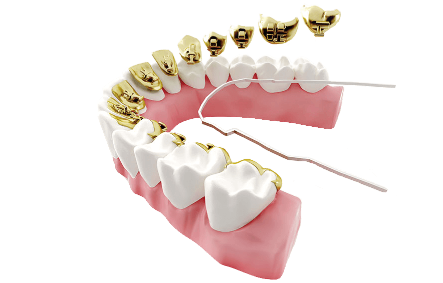 カスタムメイド舌側矯正歯科装置